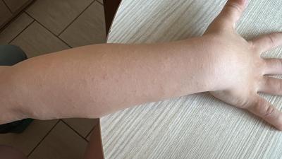 Vše možné | Kožní vyrážka  u dítě 6let