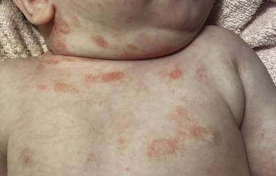 Alergie a ekzémy | Vyrážka u 4 měsíční holčičky