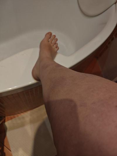 Zdravotní potíže dospělých | Zánět žil? + Foto