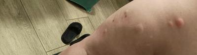 Alergie a ekzémy | Co to je za štípanec?