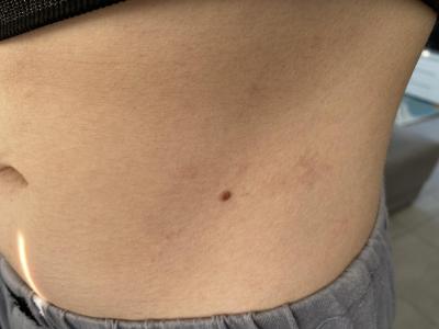 Alergie a ekzémy | Červené Fleky na břichu a bokách