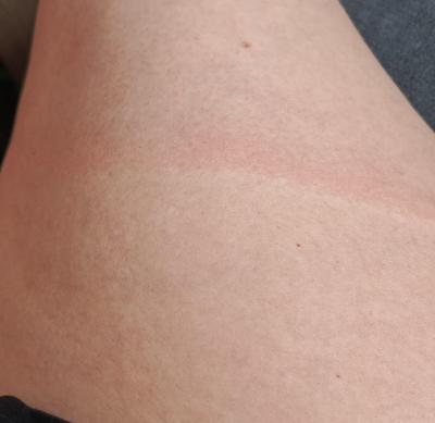 Zdravotní potíže dospělých | Červený pruh přes stehno
