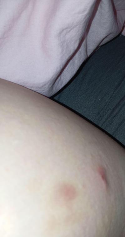 Alergie a ekzémy | Vyrážka a modřiny