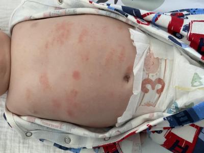 Dětské nemoci | Vyrážka u kojence, prosím o radu