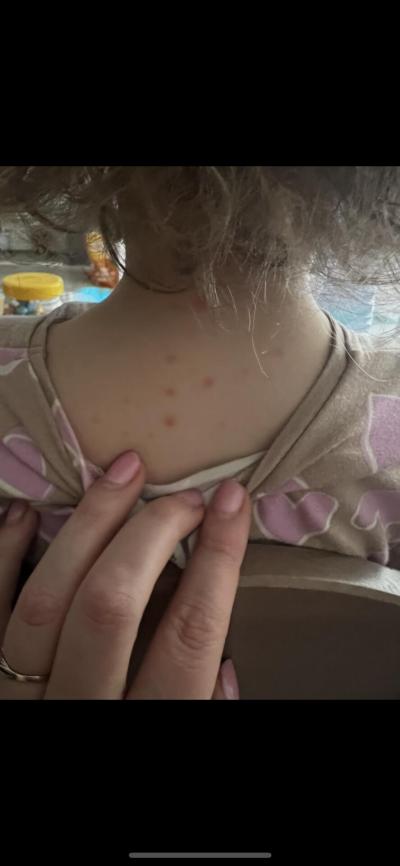 Dětské nemoci | Neštovice s pomalým průběhem?