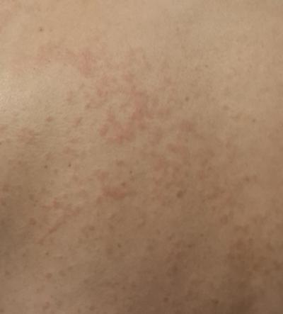 Alergie a ekzémy | Zada vyrážka