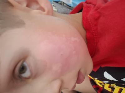 Dětské nemoci | Angina streptokok