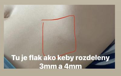 Dětské nemoci | Co je to za fleky na těle? Mám strach z neurofibrózy