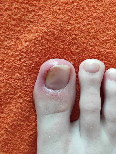 Zdravotní potíže dospělých | Zarůstající nehet a oteklý prst - navštívit lékaře?