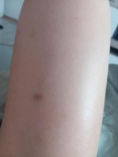 Alergie a ekzémy | Vyrážka a modřiny