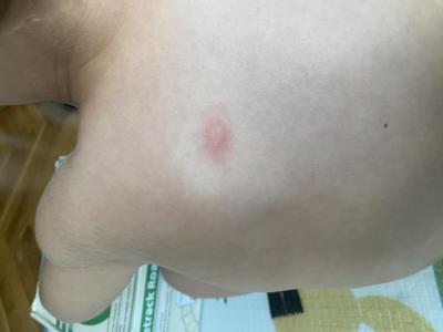 Dětské nemoci | Pupen na zádech u 3letaka
