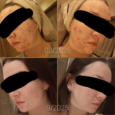 Zdravotní potíže dospělých | Isotretinoin