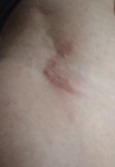 Alergie a ekzémy | Něco cosi na těle