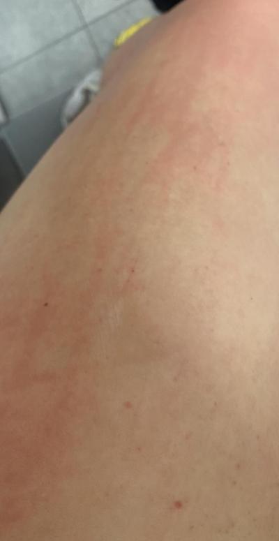 Alergie a ekzémy | Vyrážka po sprše