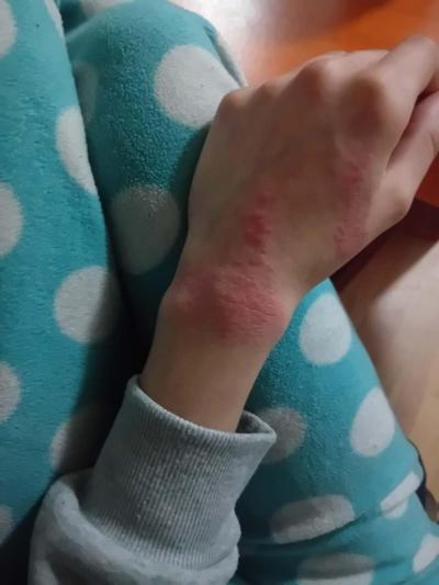 Alergie a ekzémy | Alergie na čistící prostředky
