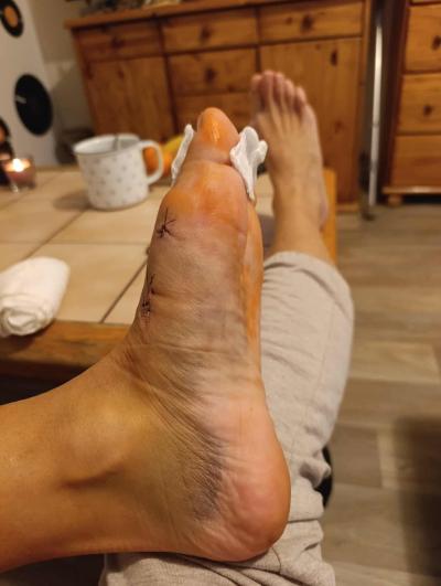 Zdravotní potíže dospělých | Operace MICA - hallux