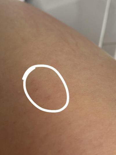 Alergie a ekzémy | Svědivé pupence