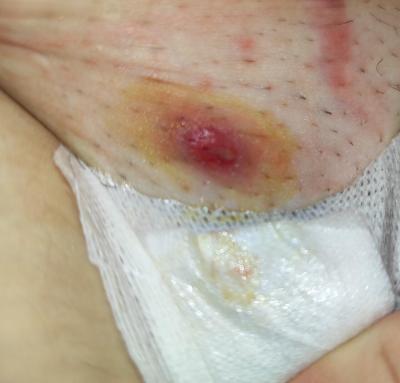 Zdravotní potíže dospělých | Foto: Bulka v intimní oblasti