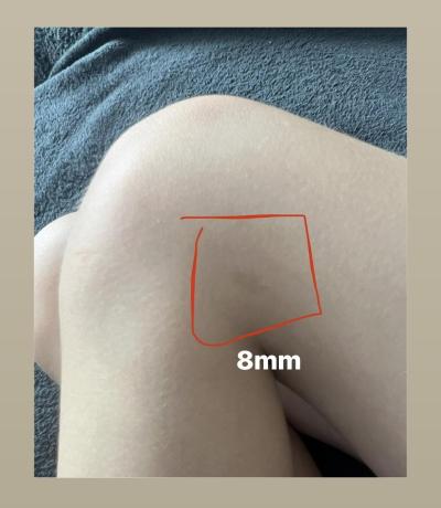 Dětské nemoci | Co je to za fleky na těle? Mám strach z neurofibrózy