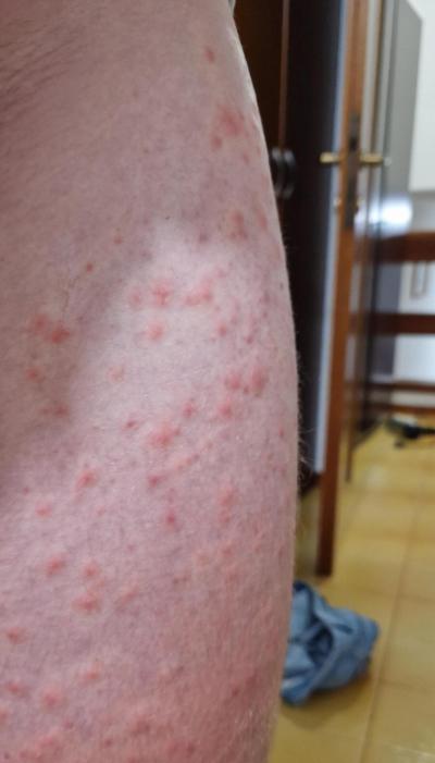 Dětské nemoci | Pupínky na dítěti