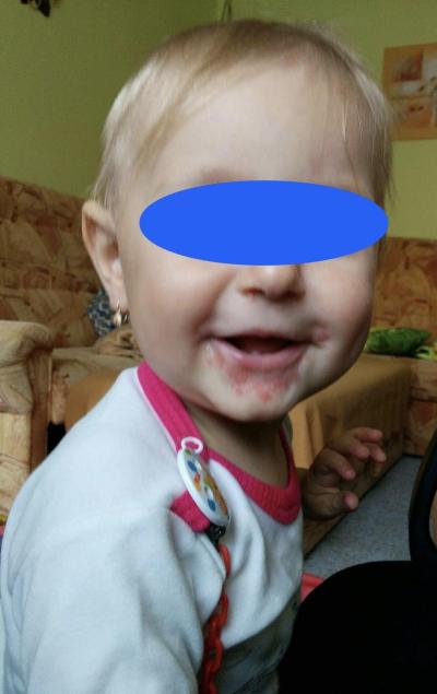 Dětské nemoci | Štípance/kousance nebo vir?
