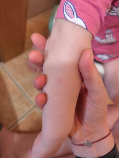 Dětské nemoci | Neštovice s pomalým průběhem?