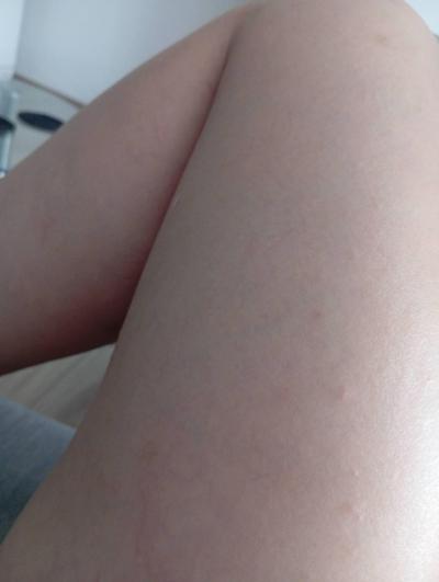 Alergie a ekzémy | Vyrážka a modřiny