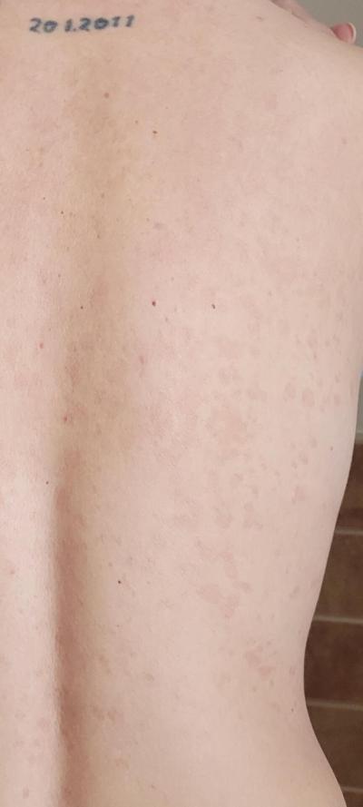 Zdravotní potíže dospělých | Vyrážka pitryasis versicolor?