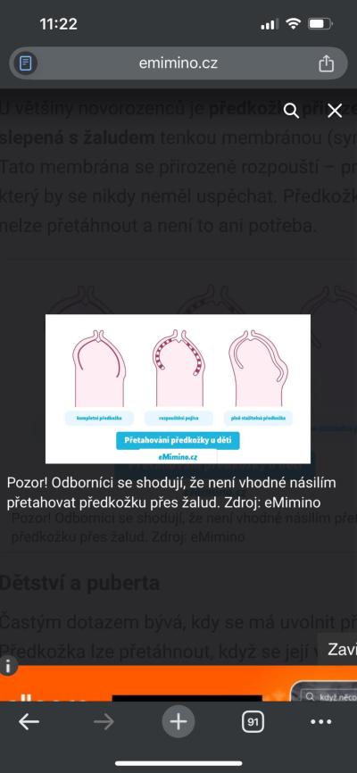 Dětské nemoci | Fimoza, zarostlá čůrací dírka?