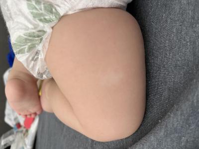 Dětské nemoci | Bile znamenko u půlročního dítěte