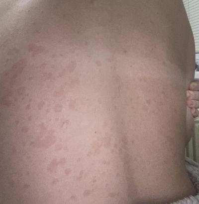 Alergie a ekzémy | Tmavé Skvrny na zádech