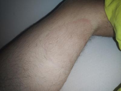 Zdravotní potíže dospělých | Flek na noze - co to může být?