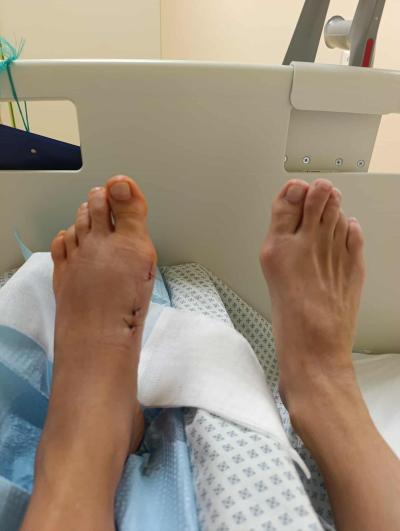Zdravotní potíže dospělých | Operace MICA - hallux