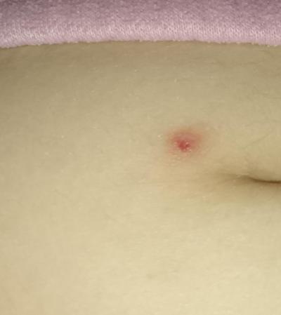 Zdravotní potíže dospělých | Pupínek po klíštětii