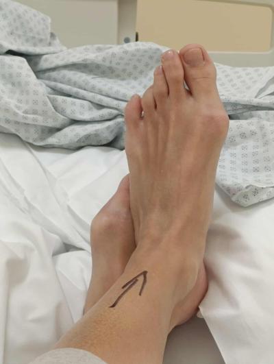 Zdravotní potíže dospělých | Operace MICA - hallux