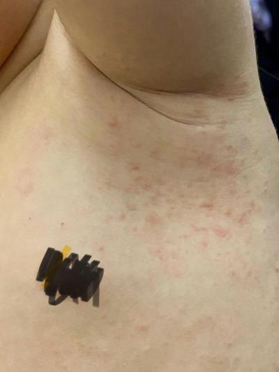 Alergie a ekzémy | Dcera ma pupínky