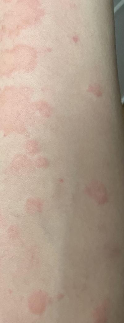 Alergie a ekzémy | Svědivé Vyrážky po těle