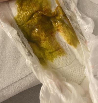 Dětské nemoci | Divná stolice u miminka -foto