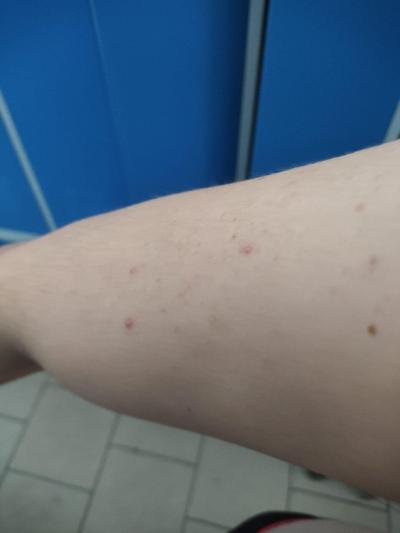 Zdravotní potíže dospělých | Neštovice příznaky