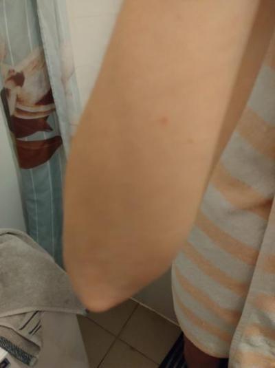 Alergie a ekzémy | Myslíte, že by to mohl být svrab?