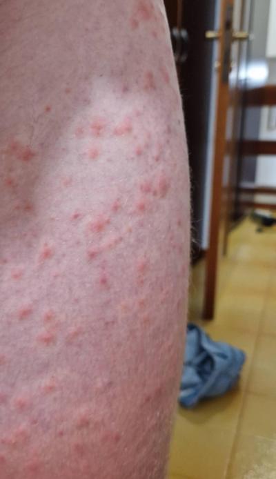 Dětské nemoci | Pupínky na dítěti