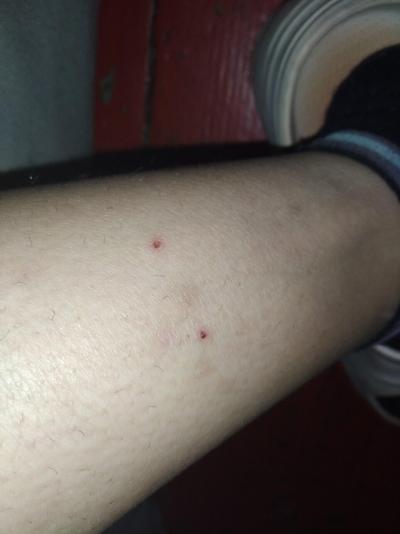 Alergie a ekzémy | Svědí mě stehna je to svrab ?