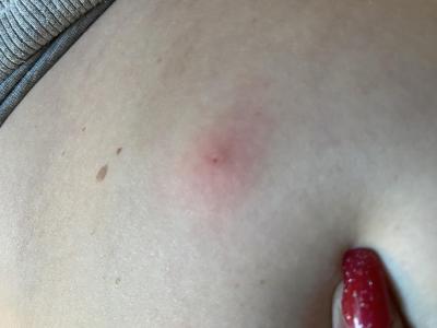 Zdravotní potíže dospělých | Klíště, kousnutí, borelioza?