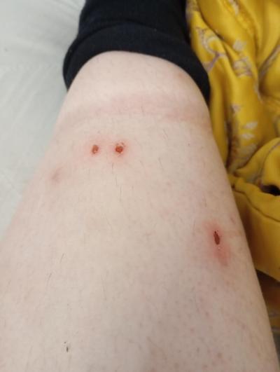 Zdravotní potíže dospělých | Štěnice, nebo blecha?