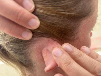 Zdravotní potíže dospělých | Boulička za uchem u dospělé
