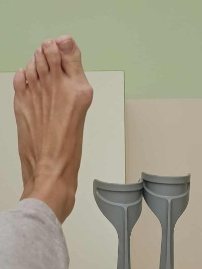 Zdravotní potíže dospělých | Operace MICA - hallux