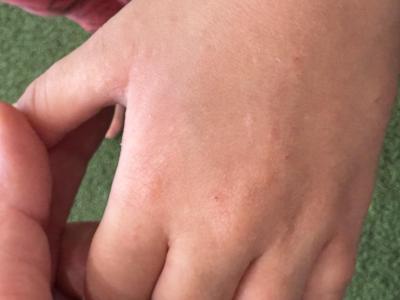 Vše možné | Kožní vyrážka  u dítě 6let