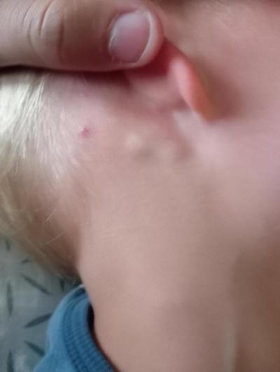 Dětské nemoci | Uzliny za uchem