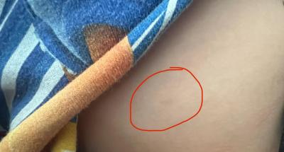 Dětské nemoci | Co su to za flaky na tele?