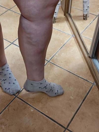 Zdravotní potíže dospělých | Zánět žil? + Foto